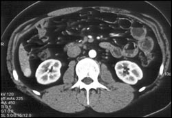 Hepatoma - CTisus CT Scan