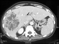 Liver Abscess - CTisus CT Scan