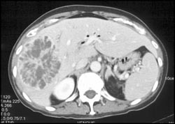 Liver Abscess - CTisus CT Scan