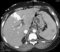 Hot Spot Liver - CTisus CT Scan