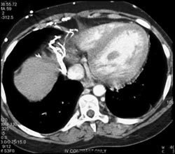 SVC Occlusion With Hot Spot and Collateral in Liver - CTisus CT Scan