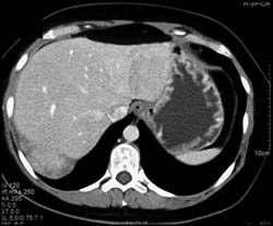 Metastatic Carcinoid With Lesions That Are Hypovascular and Hypervascular - CTisus CT Scan