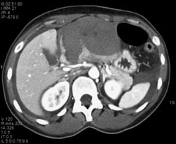 Acute Bleed Following Left Lobe of Liver Biopsy - CTisus CT Scan