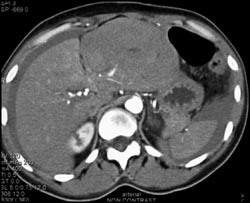 Site of Active Bleed From Branch of Left Hepatic Aa Following Biopsy - CTisus CT Scan