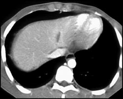 Trauma With Hepatic ??? - CTisus CT Scan