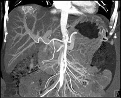 Hemangioma - CTisus CT Scan