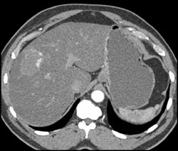 Hemangioma - CTisus CT Scan