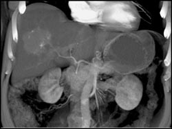 Hemangioma - CTisus CT Scan