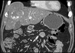 Hemangioma - CTisus CT Scan