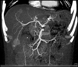 Metastatic Islet Cell - CTisus CT Scan