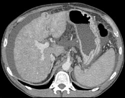 Hepatoma in A Cirrhotic Liver - CTisus CT Scan