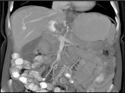 Hemangioma - CTisus CT Scan