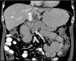 Hemangioma - CTisus CT Scan