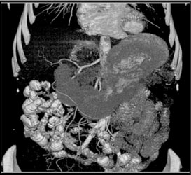 Hemangioma - CTisus CT Scan