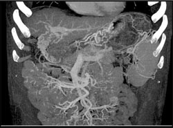 Cirrhosis With Varices - CTisus CT Scan