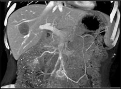 Cirrhosis With Varices - CTisus CT Scan