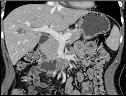 Hemangioma - CTisus CT Scan