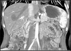 Early Phase Scan Shows Density of Lesions and IVC and Hepatic Veins Are Equal - CTisus CT Scan