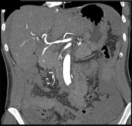 Subtle Aneurysm With Bleed in Left Lobe of Liver - CTisus CT Scan