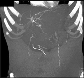 Bleed With CTA Shows Bleed - CTisus CT Scan