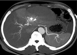 S/P Embolization of Hepatic Aa Aneurysm - CTisus CT Scan