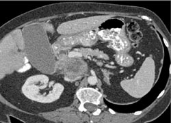 Dilated Biliary Ducts With Nodes in Portocaval Space - CTisus CT Scan