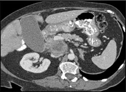 Mass in Distal Common Bile Duct (CBD) - CTisus CT Scan