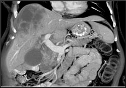 Mass in Distal Common Bile Duct (CBD) With Liver Metastases - CTisus CT Scan