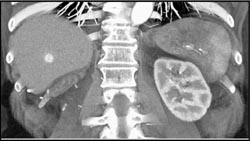 Hemangioma - CTisus CT Scan