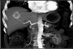 Hemangioma - CTisus CT Scan