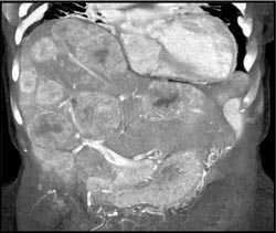 Metastatic ??? Tumor - CTisus CT Scan