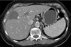 Post Rf ??? - CTisus CT Scan