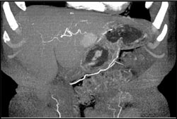 Hepatoma?? - CTisus CT Scan