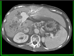 Cholangiocarcinoma - CTisus CT Scan