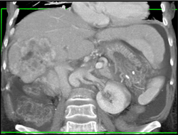 Cholangiocarcinoma - CTisus CT Scan