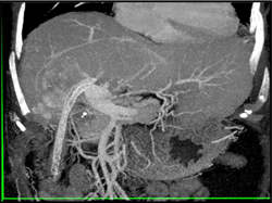 Cholangiocarcinoma - CTisus CT Scan