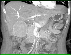 Hepatoma - CTisus CT Scan