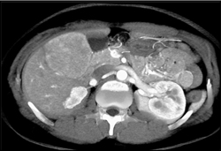 Hepatoma - CTisus CT Scan