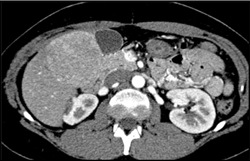 Hepatoma - CTisus CT Scan