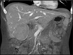 Hepatoma - CTisus CT Scan