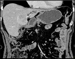 Dilated Ducts Left Lobe of Liver - CTisus CT Scan