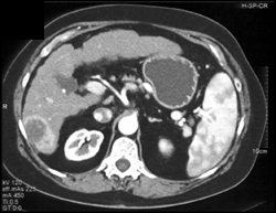 Hepatomas in A Cirrhotic Liver - CTisus CT Scan