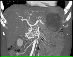 CTA Liver - CTisus CT Scan