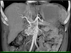 Prominent Gastroduodenal Artery (GDA) - CTisus CT Scan