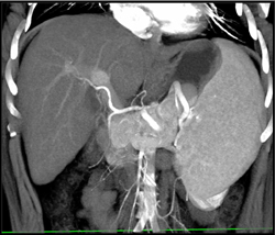 Hemangioma and Large Spleen - CTisus CT Scan