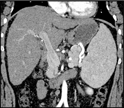 Large Spleen - CTisus CT Scan