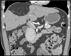 Post Hepatic Resection - CTisus CT Scan