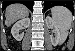 Cirrhosis With 1cm Hepatocellular Carcinoma (HCC) - CTisus CT Scan