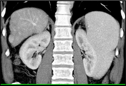 1cm Hepatocellular Carcinoma (HCC) - CTisus CT Scan