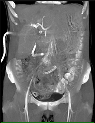 Hepatoma - CTisus CT Scan